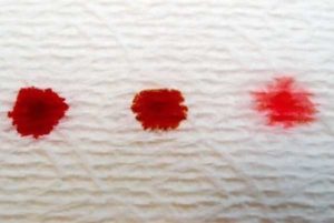Кровянистые выделении после лонгидазы