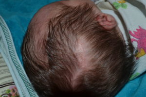Красные пятна на голове и облысение ребёнка 2 года