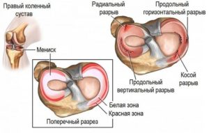 Боль в колене после операции миниска