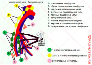 Лимфоузлы при раке шейки матки