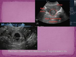 Боюсь внематочной беременности