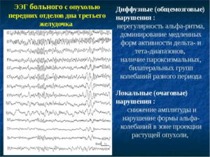 Инцефолограмма нужно ли наблюдение в динамике