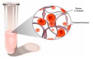 Кровь в моче и сперме