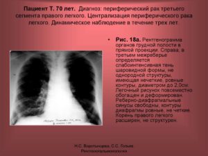 Бурление в легких, расшифруйте диагноз