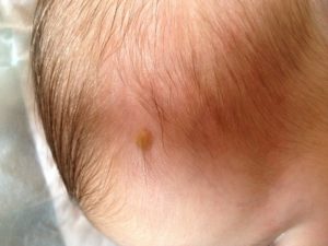 Мелкие коричневые образования на голове у ребёнка