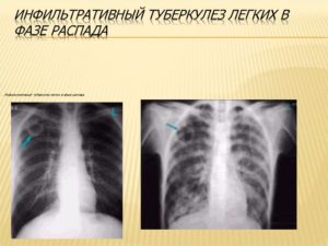 Инфильтративный туберкулёз фаза распада