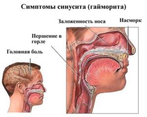 Боль в горле, заложенность носа