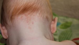 Красные пятна на лице и шеи у ребенка?