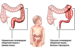 Болезнь гиршпрунга консультация врача