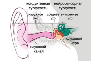 Будет ли тугоухостьот Анаурана при перфорации?