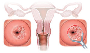 Хронический цервицит вместо дисплазии