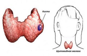 Кисты и аденома щитовидной железы