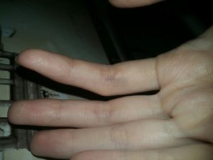 Болит большой палец на руке. Имеются синие точки