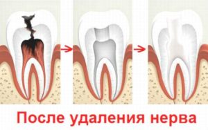 Болит зуб после наложения лекарства