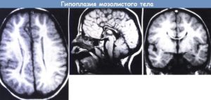 Частичная гипоплазия мозолистого тела