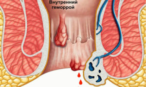 Болезненный синеватый шарик возле ануса