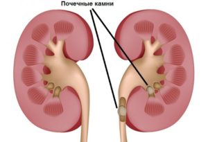 Боли в области почки при полном мочевом пузыре