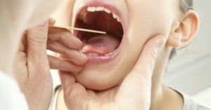 Хронический тонзиллит и запах изо рта