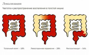 Как лечить катаральный колит, от него ли ли субфебрилитеет