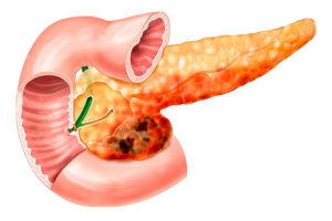 Хронический панкреатит