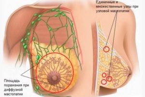 Болит лимфоузел при лечении мастопатии