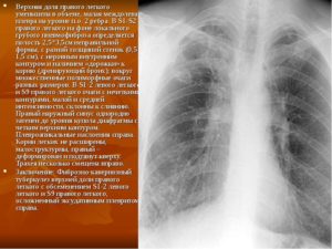 Локальный фиброз н/доли справа