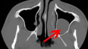 Киста в гайморовой пазухе