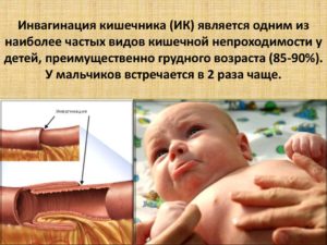 Инвагинация кишечника у новорожденного