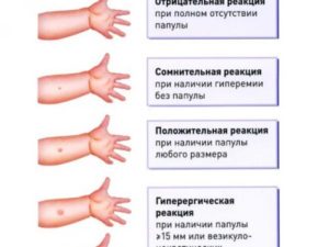 Манту при простуде