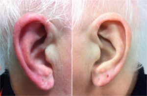 Перелом/трешина в хряще уха