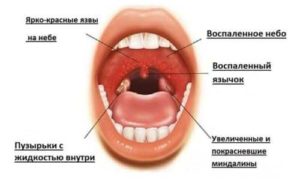 Мелкая сыпь в горле