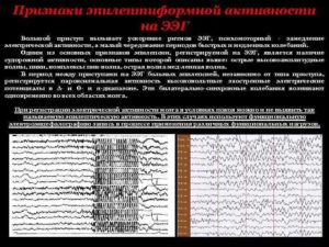 Изменения у ребенка ЭЭГ с элементами эпилептиформной активности