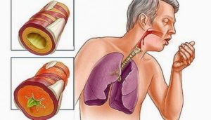 Кашель с трудно отходящей мокротой