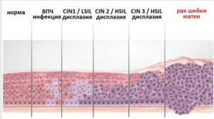 Легкая дисплазия и впч 16,31,33,35,52,58