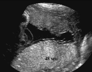 Перикардиалтный выпот у плода 3,2 мм