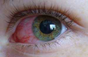 Кровоизлияние в глаз при коньюктивите