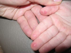 Красная точка на подушечке пальца