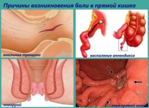 Боль в прямой кишке и промежности