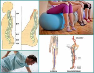 Болит поясница и плоскостопие