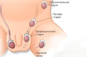 Крипторхизм неопущенное яичко