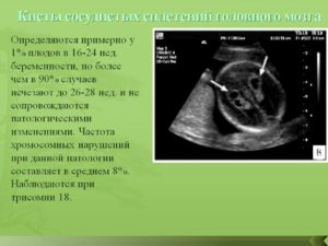 Кисты сосудистого сплетения левого бокового желудочка головного мозга плода