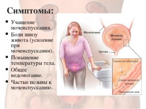 Боль при мочеиспускании, тянущие боли внизу живота