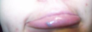 Красно - синяя шишка на половой губе