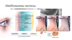 Инфаркт мейбомиевой железы