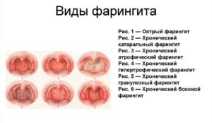 Хронический субатрофический фарингит