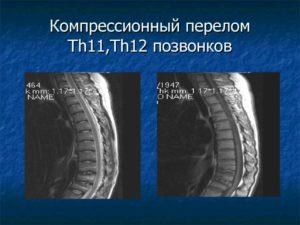 Компрессионный перелом 11 и 12 позвонков