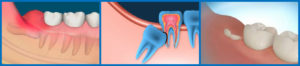 Болит десна на месте удалённого зуба