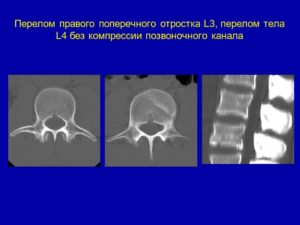 Перелом правого поперечного отростка