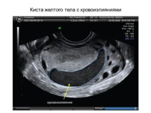 Киста желтого тела с последующим кровоизлиянием