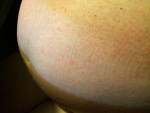Мелкая сыпь на теле во время беременности и после родов